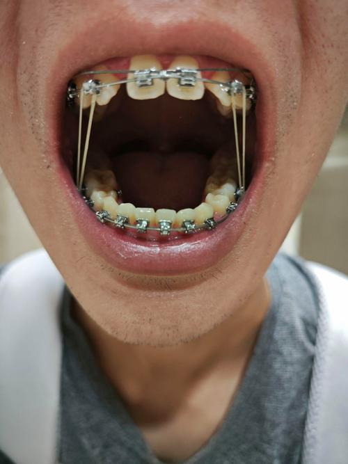 22岁牙齿矫正吗-图3 22岁牙齿矫正吗-图3