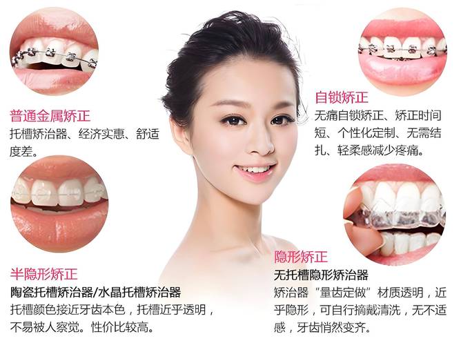 牙齿矫正的好方法-图1