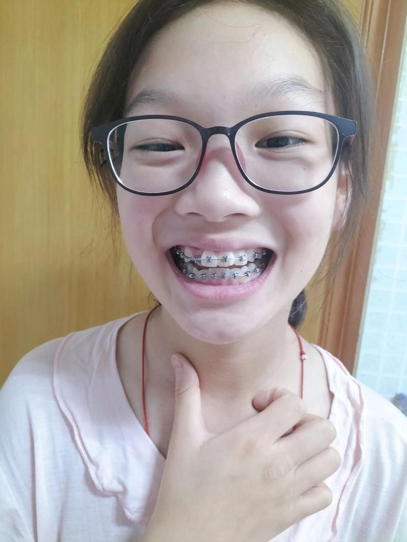 山西好的矫正牙齿-图1