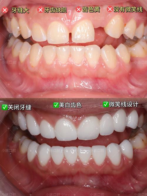 牙贴面和矫正牙齿，哪种更适合牙齿矫正？-图1