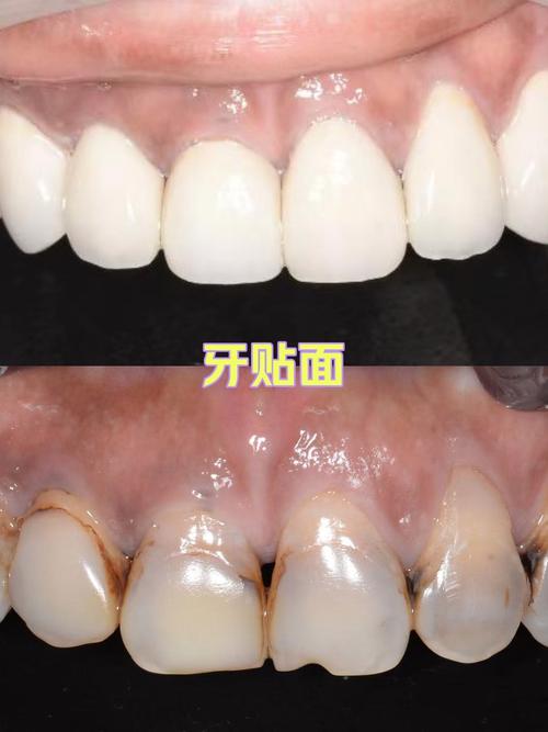 牙贴面和矫正牙齿，哪种更适合牙齿矫正？-图3
