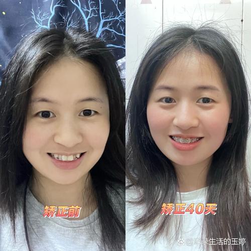 牙齿矫正前后图片变化究竟有多大？-图2