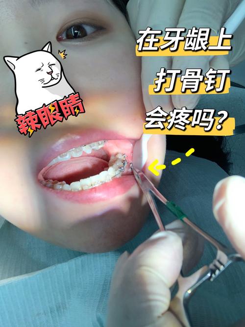 矫正牙齿为啥要打钉子?种植钉到底有啥用?-图1 矫正牙齿为啥要打钉子?种植钉到底有啥用?-图1