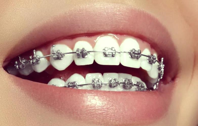 矫正牙齿隐形托槽-图1