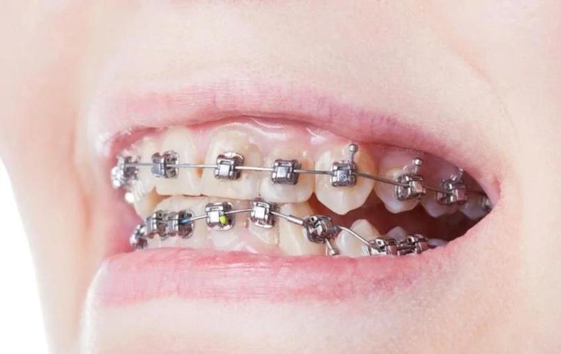 矫正牙齿隐形托槽-图3