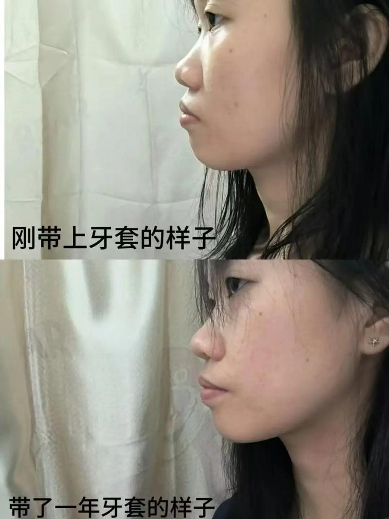 矫正牙齿脸会变吗-图1