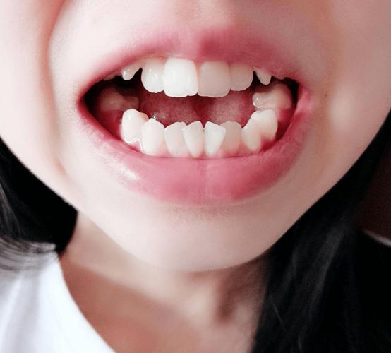 最便宜的矫正牙齿安全吗?效果能保证吗?-图2 最便宜的矫正牙齿安全吗?效果能保证吗?-图2