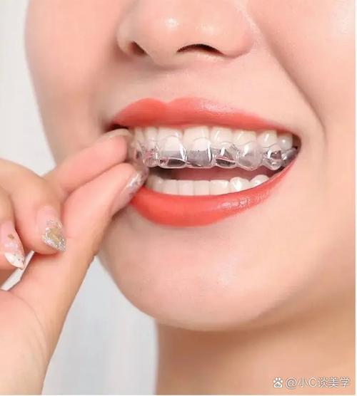 牙齿矫正不带牙套-图1