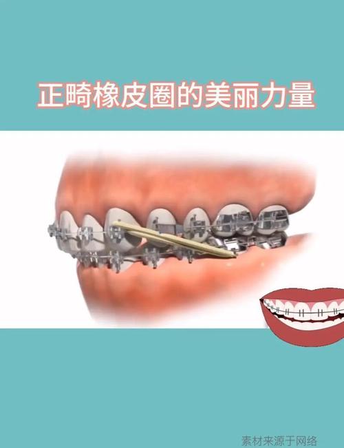 矫正牙齿的橡皮圈有何用？使用时要注意什么？-图2