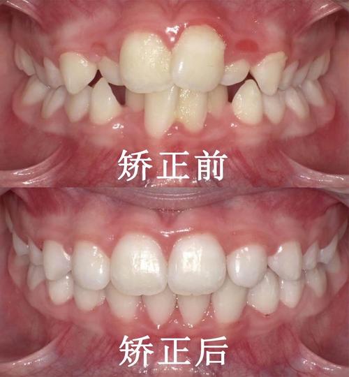 儿童牙齿的矫正吗-图2 儿童牙齿的矫正吗-图2