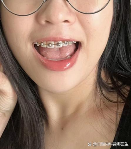 32岁 牙齿矫正-图1 32岁 牙齿矫正-图1