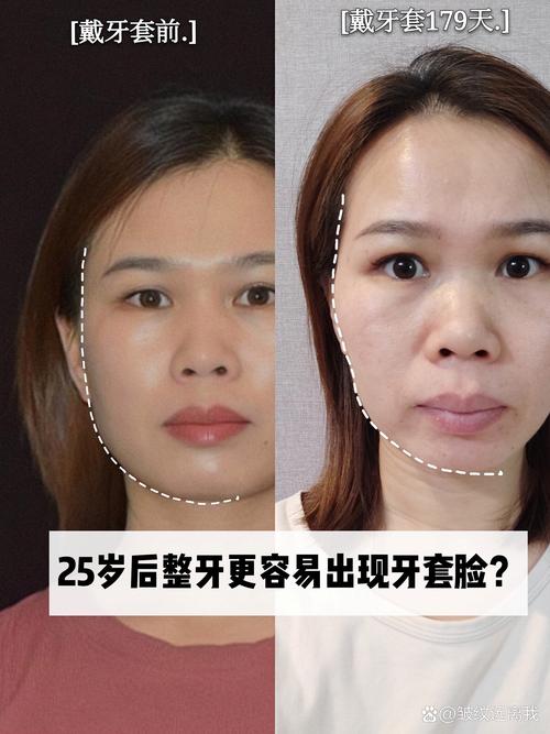 25岁矫正牙齿吗-图2 25岁矫正牙齿吗-图2