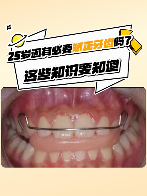 25岁矫正牙齿吗-图1 25岁矫正牙齿吗-图1