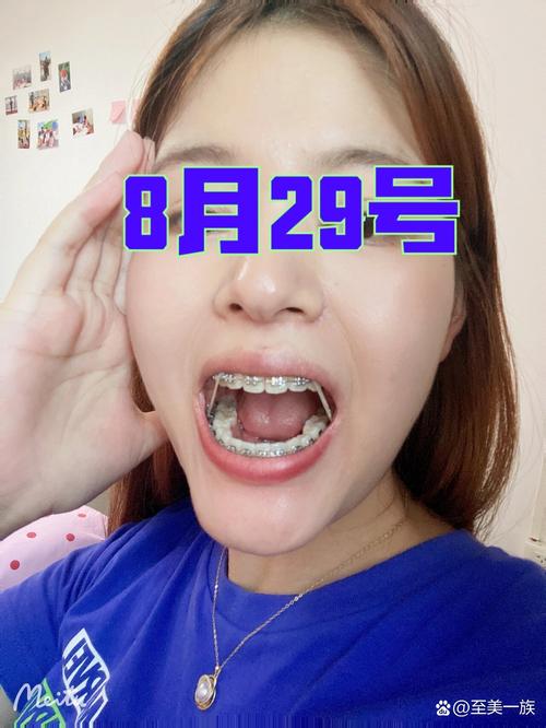 25岁矫正牙齿吗-图3 25岁矫正牙齿吗-图3