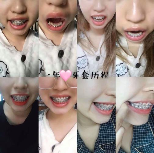 28岁矫正牙齿晚吗？效果会打折扣吗？-图1