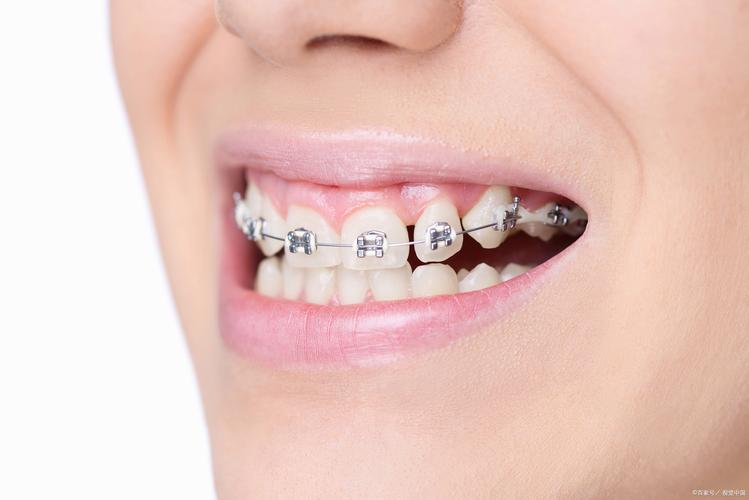 成年 牙齿 矫正-图3