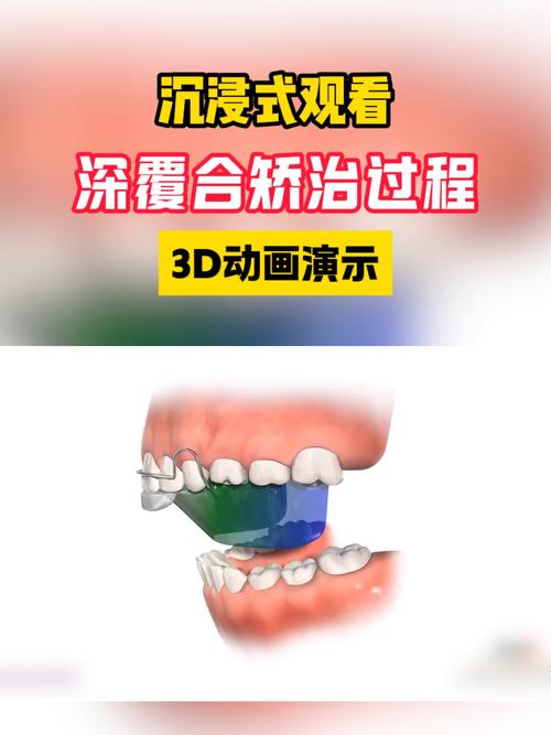 矫正牙齿成深覆合-图2