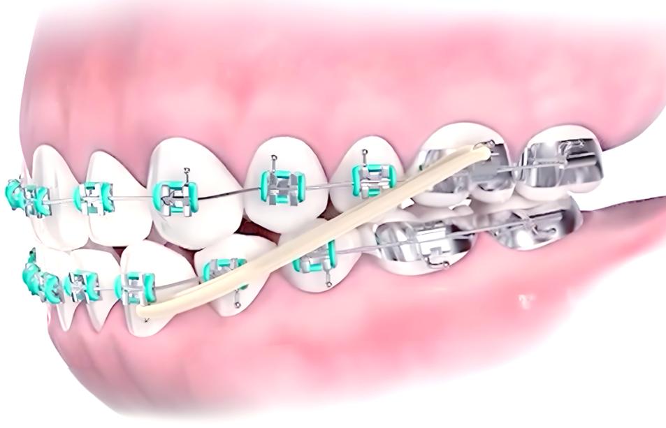 牙齿矫正皮筋中线-图1 牙齿矫正皮筋中线-图1