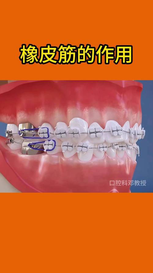 牙齿矫正皮筋中线-图2 牙齿矫正皮筋中线-图2