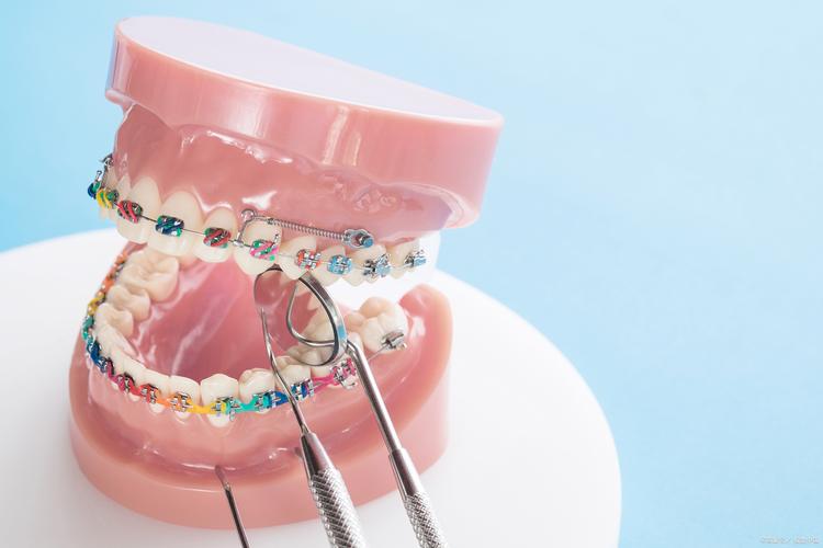 牙齿矫正皮筋中线-图3 牙齿矫正皮筋中线-图3