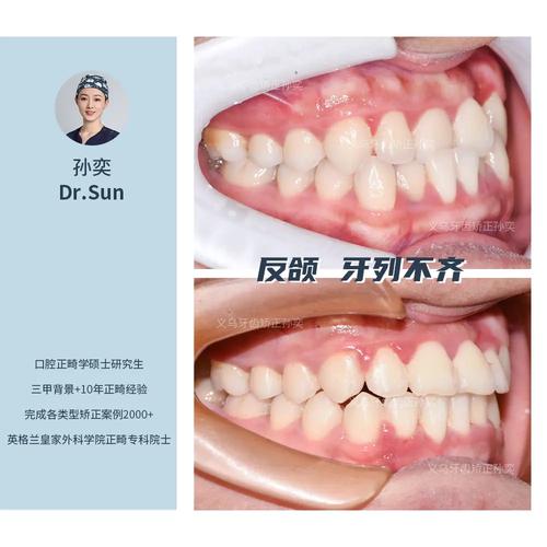牙齿错位矫正案例中矫正效果如何体现？-图1