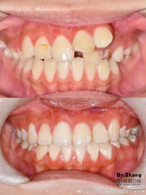牙齿错位矫正案例中矫正效果如何体现？-图2