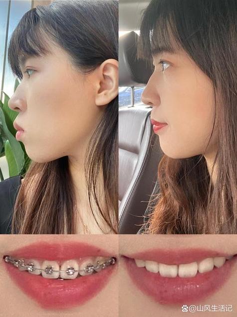 牙齿矫正会导致颧骨下移吗？矫正后颧骨变化的深层原因是什么？-图1