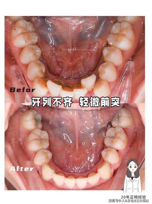牙齿矫正会导致颧骨下移吗？矫正后颧骨变化的深层原因是什么？-图3