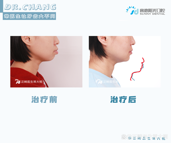 牙齿矫正会导致颧骨下移吗？矫正后颧骨变化的深层原因是什么？-图2