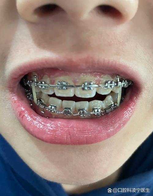 矫正牙齿嘴巴突出是什么原因?该如何有效改善?-图1 矫正牙齿嘴巴突出是什么原因?该如何有效改善?-图1
