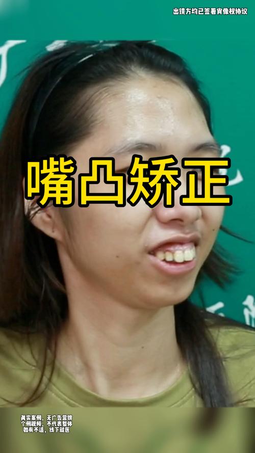 矫正牙齿嘴巴突出是什么原因?该如何有效改善?-图2 矫正牙齿嘴巴突出是什么原因?该如何有效改善?-图2