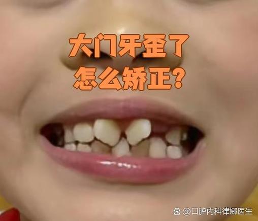 牙齿矫正后为何又歪了？反弹原因与解决方法详解？-图2