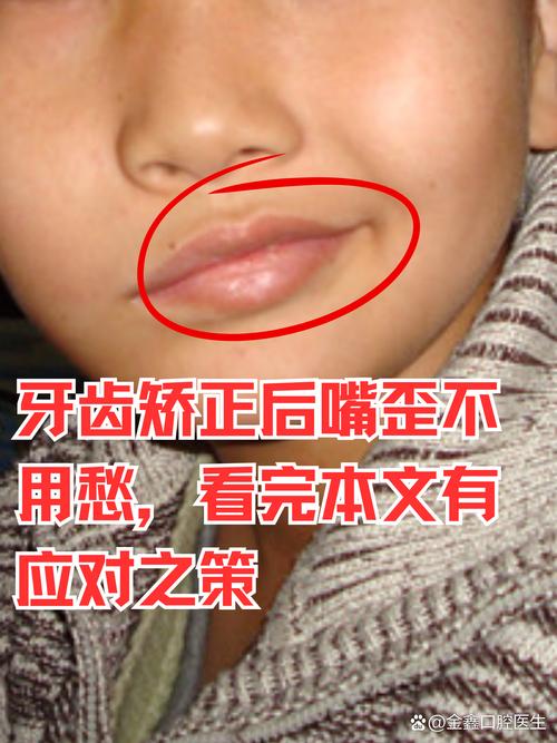 牙齿矫正后为何又歪了？反弹原因与解决方法详解？-图3