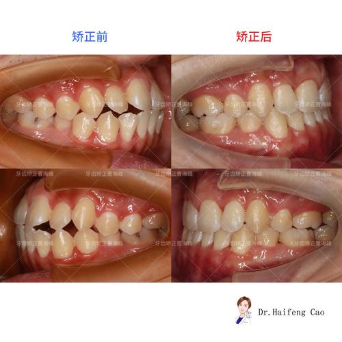 牙齿缺失矫正牙齿-图3 牙齿缺失矫正牙齿-图3