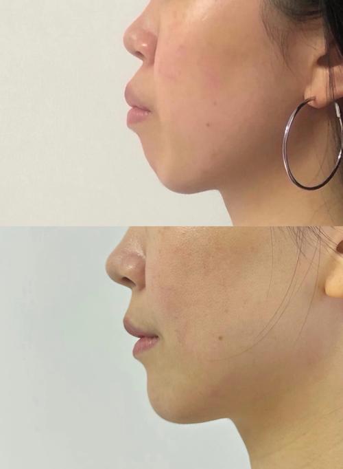 矫正牙齿后脸歪了？矫正真的会让脸变歪吗？-图1