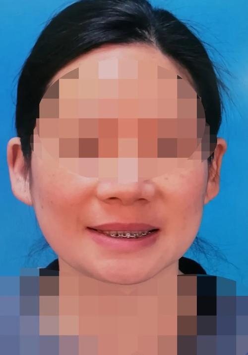 矫正牙齿后脸歪了？矫正真的会让脸变歪吗？-图2
