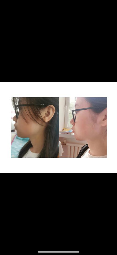 矫正牙齿后脸歪了？矫正真的会让脸变歪吗？-图3