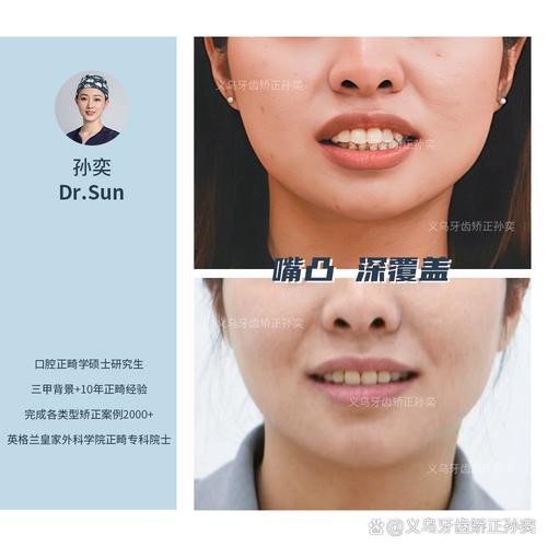 矫正一半出国，后续治疗如何继续进行？-图2