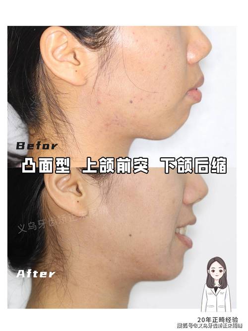 矫正牙齿会导致脸变宽吗？-图2