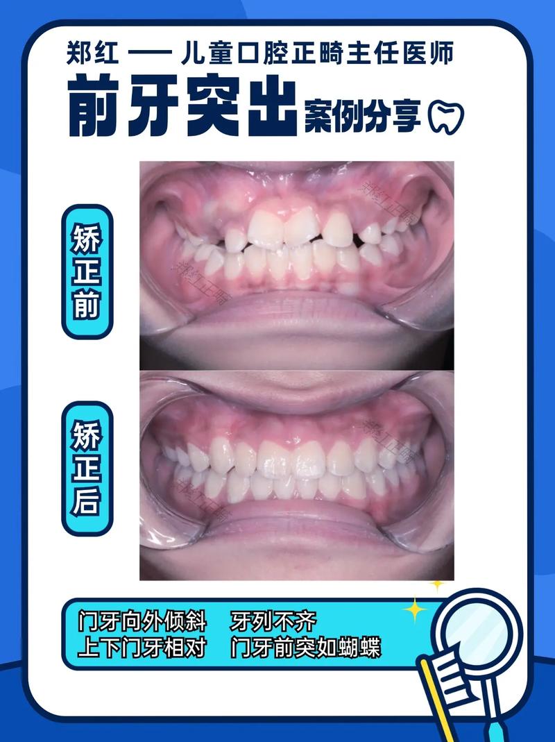 牙齿龅牙矫正有哪些有效方法？-图1