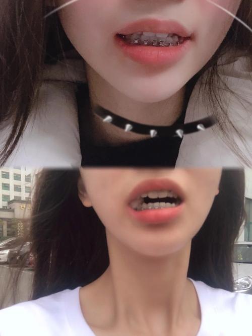 女孩牙齿矫正图片能直观展示矫正前后的牙齿变化吗？-图1
