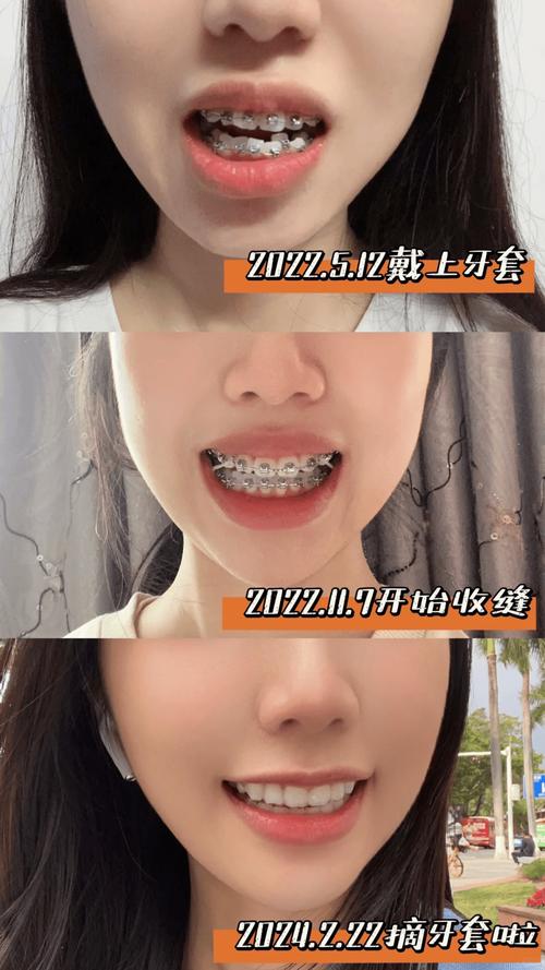 女孩牙齿矫正图片能直观展示矫正前后的牙齿变化吗？-图3