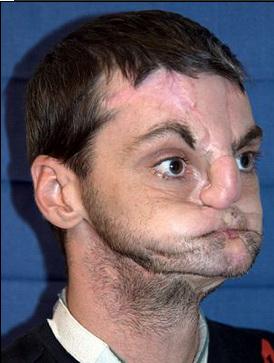 英国矫正牙齿价格区间是多少？不同方案费用差多少？-图2