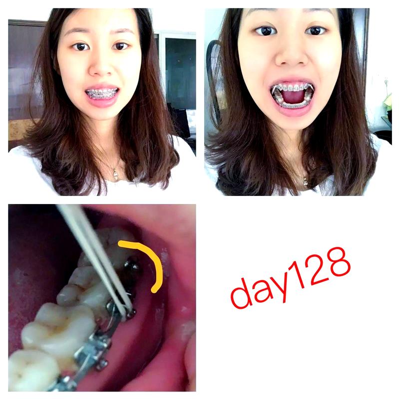 矫正牙齿收缝视频能看懂收缝过程和效果吗？-图3