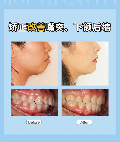 孕期矫正牙齿安全吗？孕妇能做牙齿矫正吗？-图3