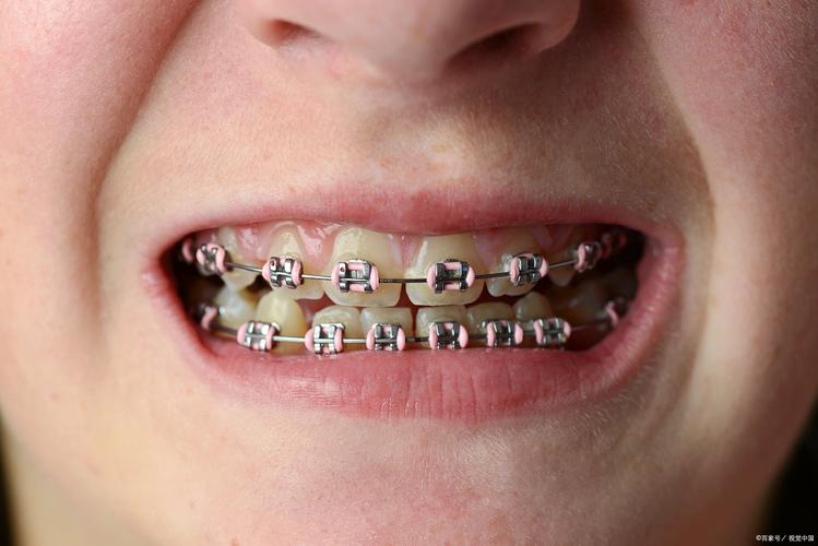 儿童牙齿矫正疼吗-图3 儿童牙齿矫正疼吗-图3