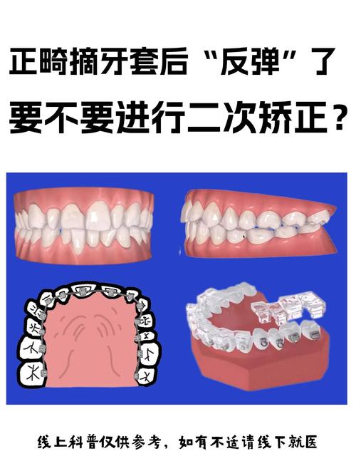 矫正过的牙齿为何会反弹？如何科学预防反弹？-图3