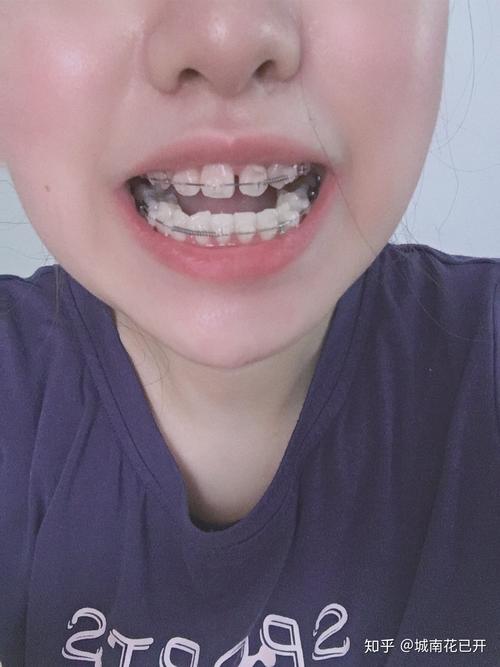 20岁做牙齿矫正-图3