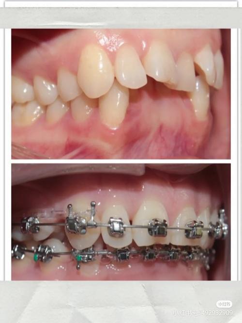 康圆口腔矫正牙齿效果如何？性价比高吗？-图1
