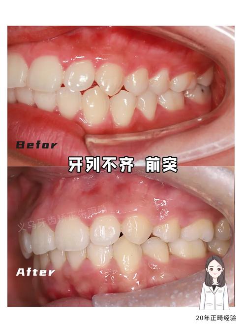 牙齿排列不齐矫正?如何选对矫正方式达到理想效果?-图1 牙齿排列不齐矫正?如何选对矫正方式达到理想效果?-图1